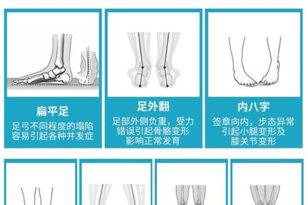 纠正外八字脚