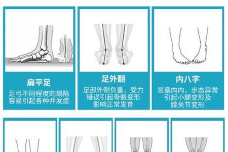 纠正外八字脚