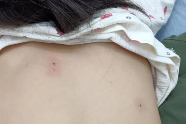 女人背部痣相图解算命