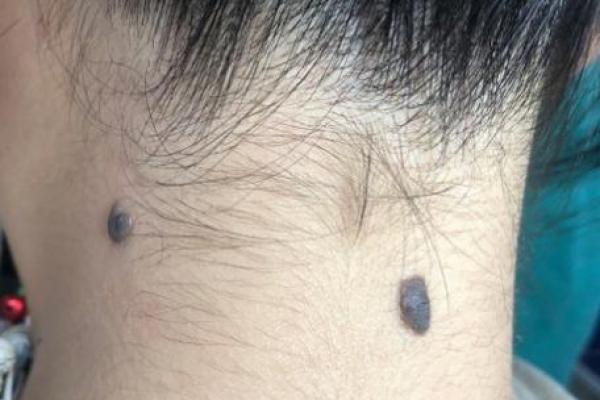 脖子上不同位置胎记算命
