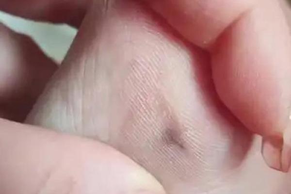 痣相风水脚底有痣的人命运好不好