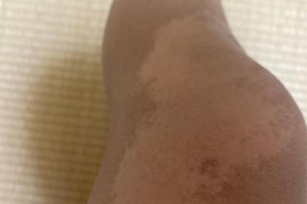 腿上有胎记算命分析